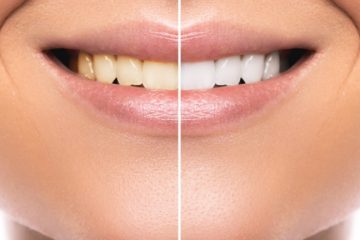 How Teeth Whitening Can Enhance Your Appearance?