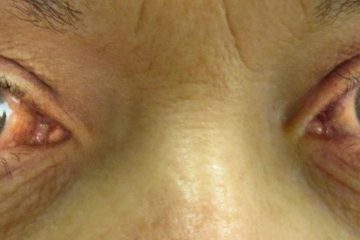 Blepharoplasty and Glaucoma: Safe Cosmetic Enhancement for Eye Health