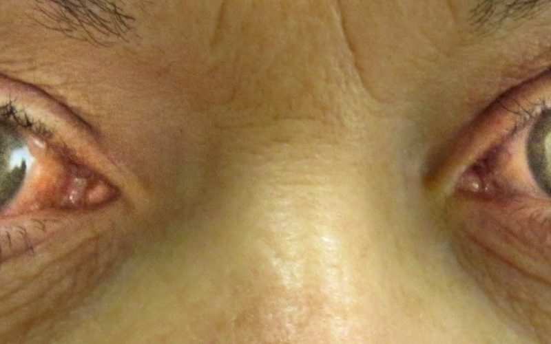 Blepharoplasty and Glaucoma: Safe Cosmetic Enhancement for Eye Health